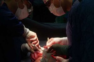 در مرکز آموزشی و درمانی ۱۷ شهریور رشت؛ خارج کردن تومور پیشرفته ویلمز از کلیه کودک ۹ساله طی عمل جراحی ۶ ساعته